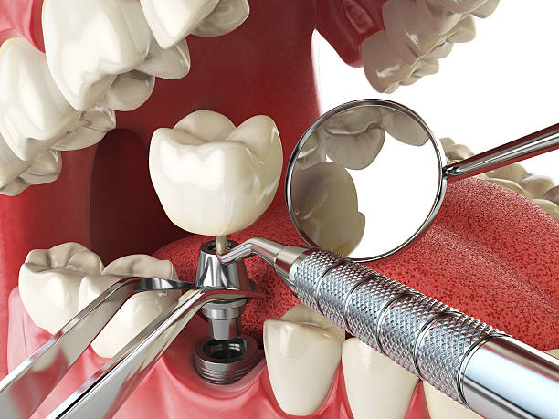Best Dental Abscess Treatment in Mount Kisco, NY
